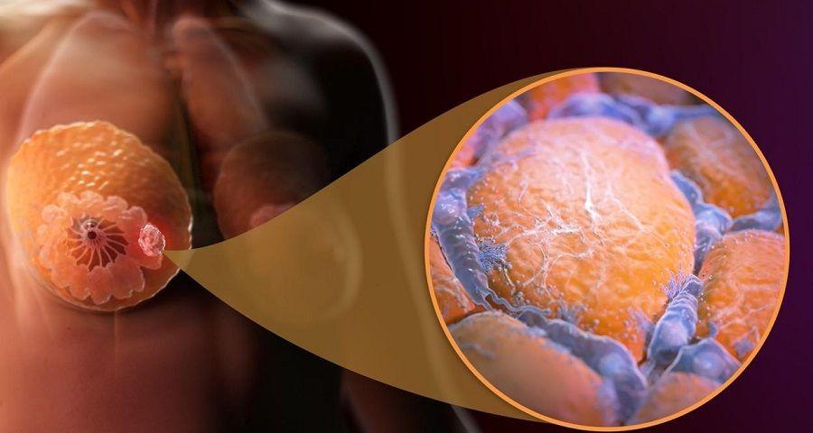 Desarrollan un nuevo tratamiento para el cáncer de mama luminal
