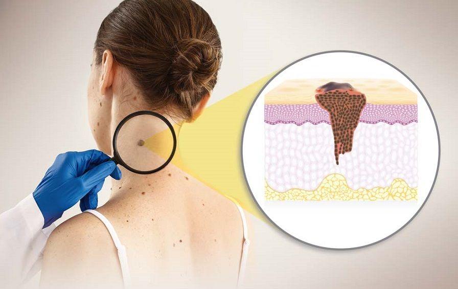 Melanoma maligno: el tipo más grave de cáncer de piel