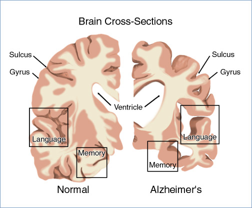 El reciclaje en las fibras de beta-amiloide podría aportar pistas sobre la causa de la enfermedad de Alzheimer