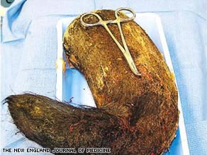  Insólito – Tenía cinco kilos de pelo en forma de bola en el estómago