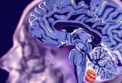 Sexo y café, factores que pueden desencadenar un derrame