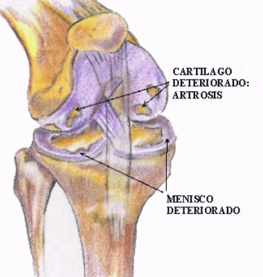 Investigadores Argentinos desarrollaron un nuevo tratamiento para la artrosis con células madre
