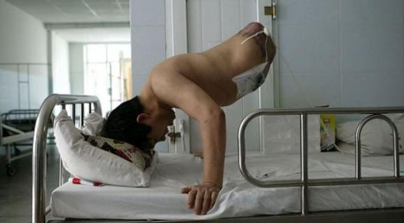 Insólito – Empresario chino vive con la mitad de su cuerpo