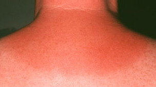 Por qué duele cuando nos quemamos con el sol  