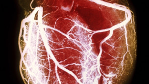 Nueva tecnología ayudará a detectar enfermedad de arterias coronarias