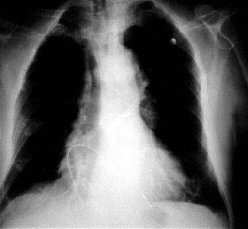 Ingeniero colombiano crea un marcapasos del tamaño de un tercio de un grano de arroz