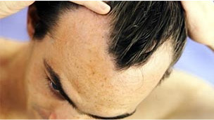 Hallan clave contra la calvicie en células grasas