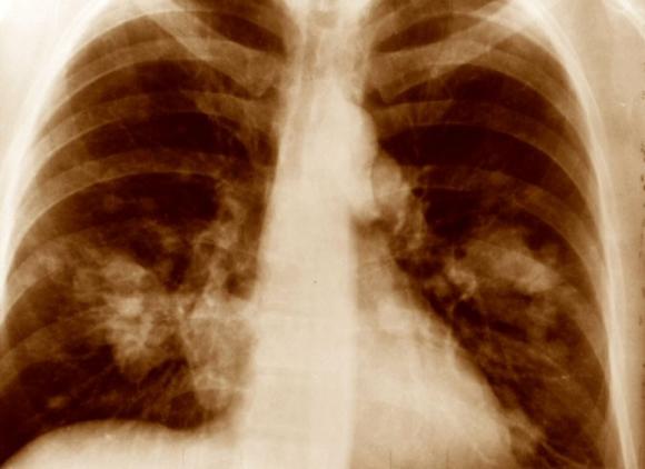 Cuando crece hueso donde debería crecer músculo.