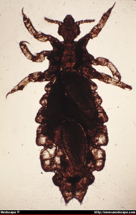 Cientificos Argentinos comprueban matemáticamente que la clave para combatir los piojos es la sincronización‏