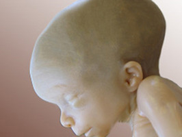 Científicos de California hallan la posible causa de la hidrocefalia