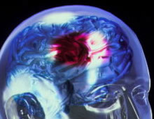Diagnóstico de derrames por televisión