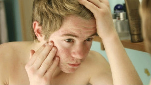 ¿Por qué es tan difícil curar el acné?