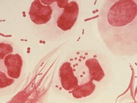 Expertos hallan primera cepa de gonorrea calificada de ´superbacteria´