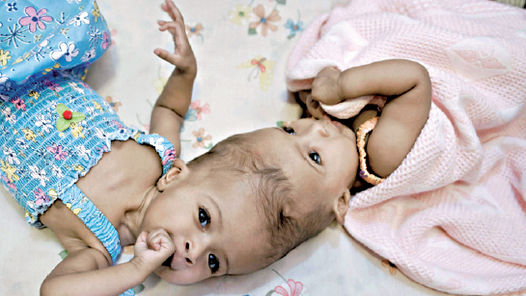 Separaron a dos siamesas que nacieron unidas por la cabeza