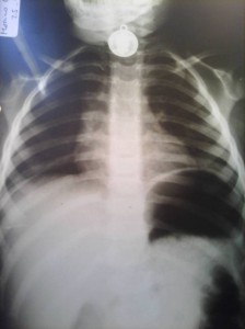 Alerta niños: cómo actuar ante la ingesta de cuerpos extraños