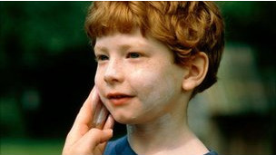 La gente de piel clara necesita más vitamina D