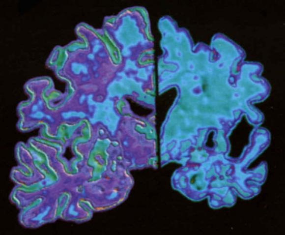  La  importancia de la detección precoz del Alzheimer 