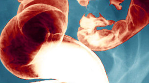 Hallan bacteria asociada al cáncer de colon y recto