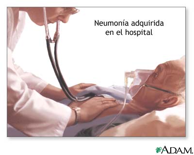 La neumonía es la infección más común tras una cirugía cardiaca