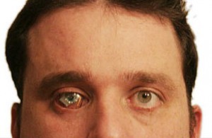 PERIODISTA TUERTO SE COLOCA “OJO BIONICO” PARA VIDEOGRABAR LO QUE VE