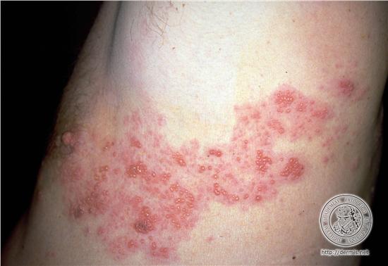 HERPES ZOSTER 