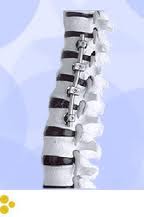 Nueva prótesis de columna made in Argentina‏