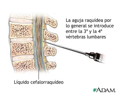Objetivos y resultados de una punción lumbar